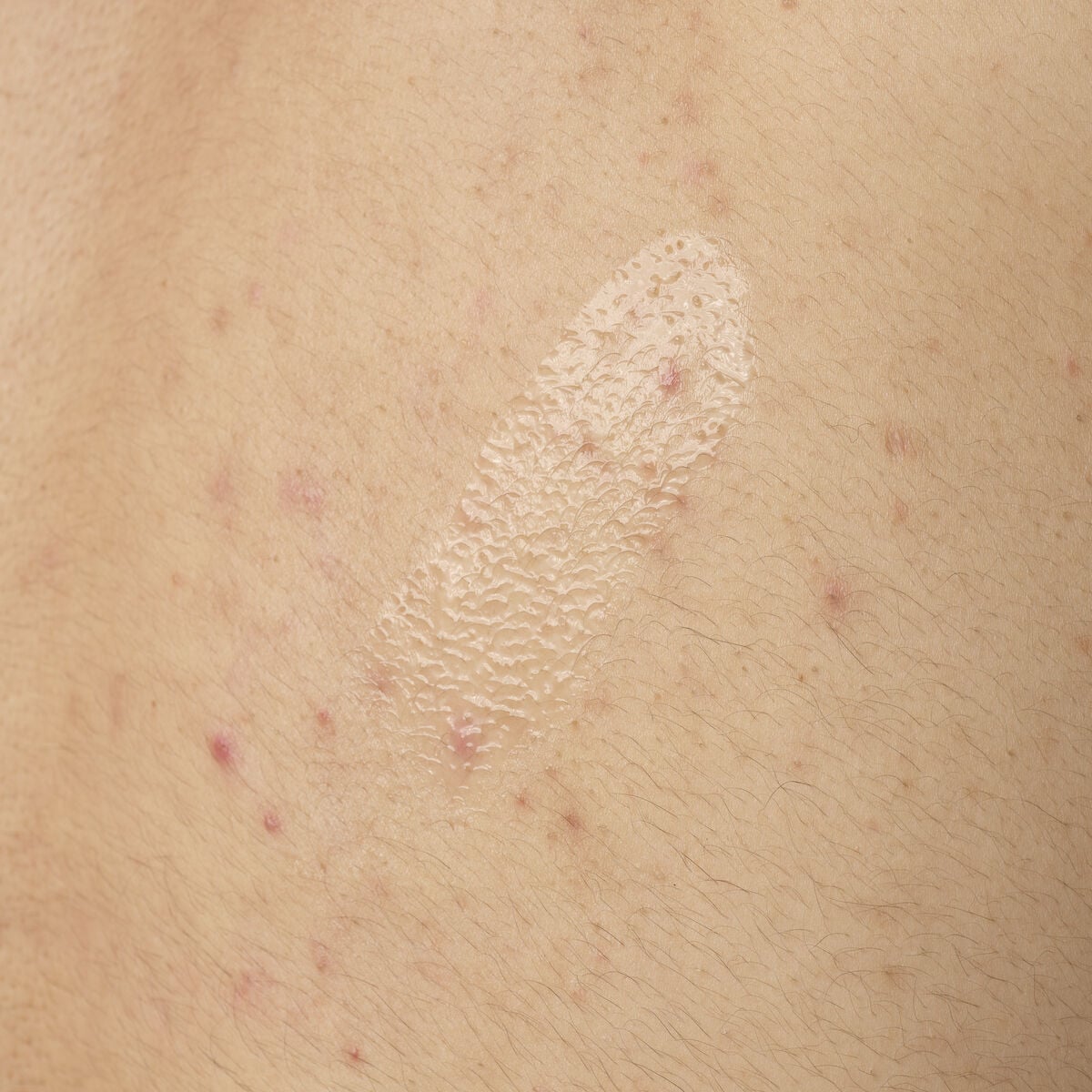 salicylic-acid-0-5-body-serum-q0 ORD-salicylic-acid-05-body-240ml-application.jpg