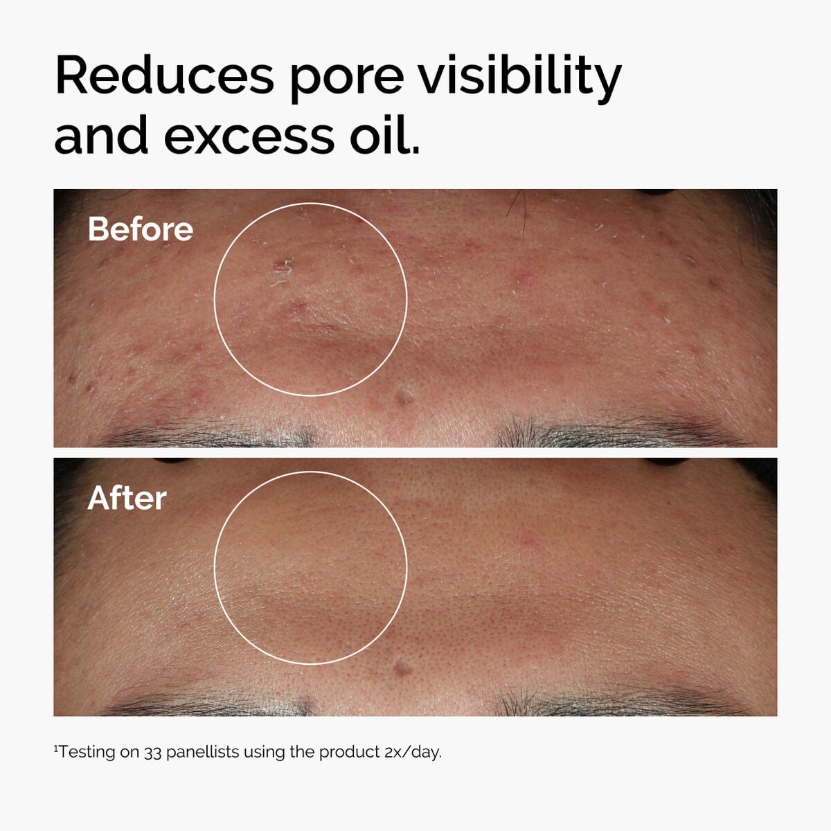 niacinamide-10-zinc-1-t4 ord-niacinamide-zinc-blemish-serum-before-after-pores.jpg