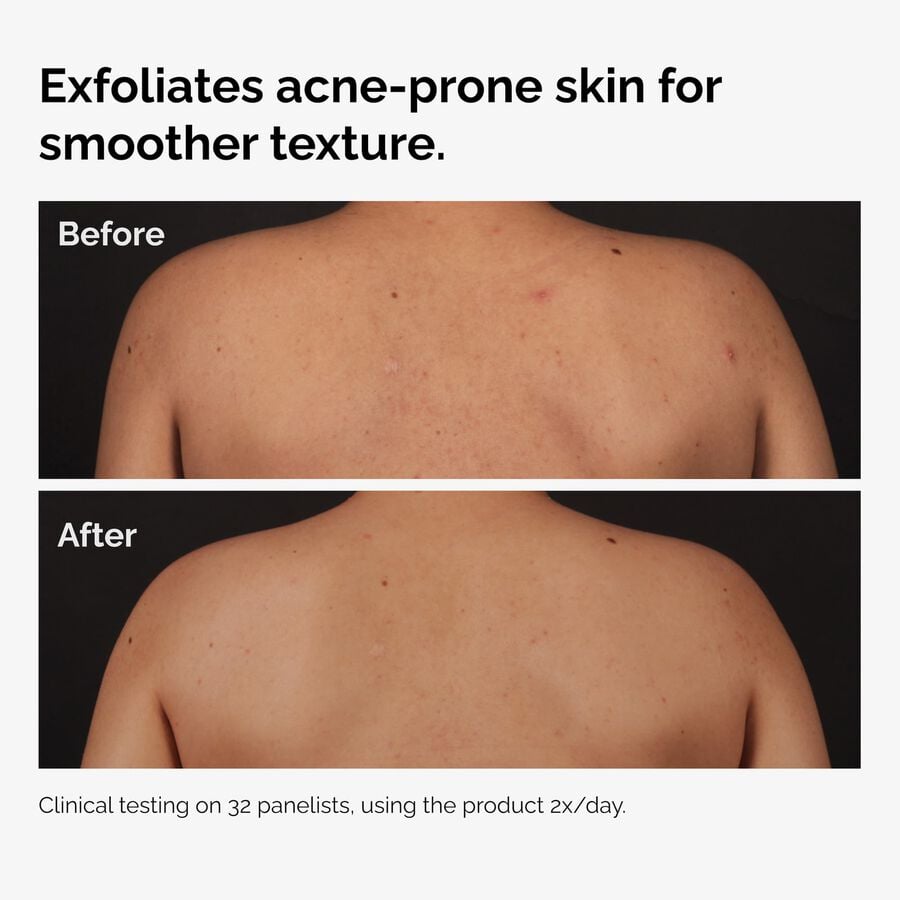 the-body-care-collection-u9 ord-salicylic-acid-body-serum-before-after-graphic-NA.jpg