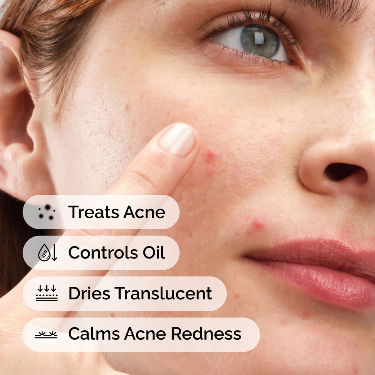 sulfur-10-powder-to-cream-concentrate-q5 ord-sulfur-10pct-powder-to-cream-concentrate-model-application-with-benefits-acne.jpg
